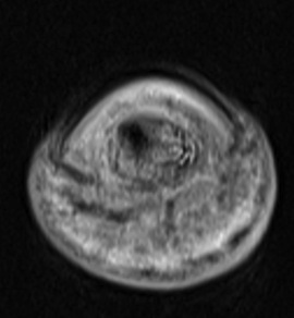 Figure 5 for case Osteoid osteoma ( RID4005 )